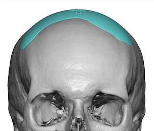 Custom sagittal dip skull implant design by Dr. Barry Eppley