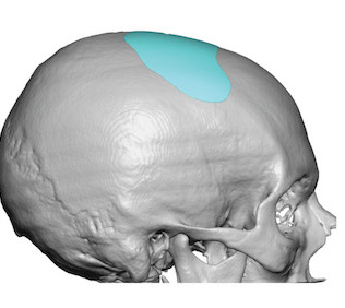 Custom sagittal dip skull implant design by Dr. Barry Eppley