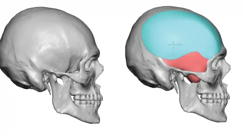 Side view of 3d rendering for before and after total temporal implant design