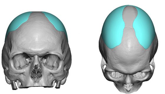 Custom skull reshaping design by Dr. Barry Eppley