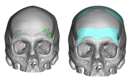 Custom Suprabrow bone and skull implant design, front view