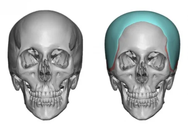 Before and after frontal view, 3d rendering of custom skull implant for narrow temples