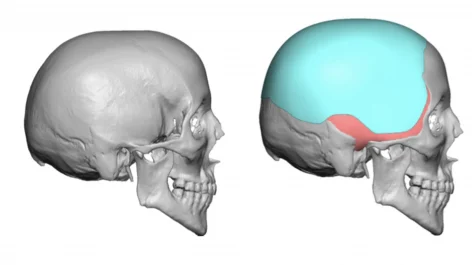 Before and after side view, 3d rendering of custom skull implant for narrow temples