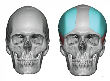 Front view of 3d rendering for before and after total temporal implant design