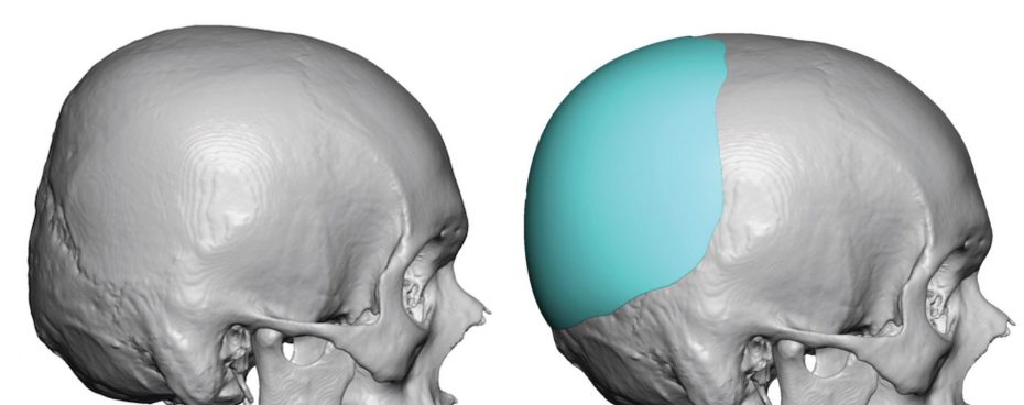 Occipital Surgery for Flat Spots on Head | Dr. Barry L. Eppley