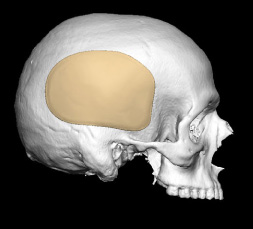 3d rendering of a posterior temporal implant