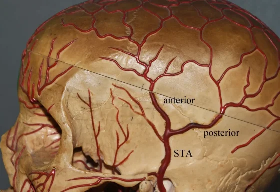 Anterior temporal branch artery