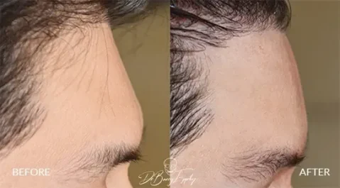 Before and after of male forehead augmentation, Dr. Barry Eppley