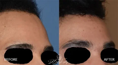 Before and after of forehead reduction by hairline advancement, Dr. Barry L. Eppley