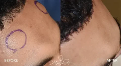 Male forehead horn reduction before and after by Dr. Barry L. Eppley