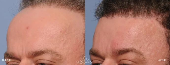 Before and after of forehead reduction by hairline advancement, Dr. Barry L. Eppley