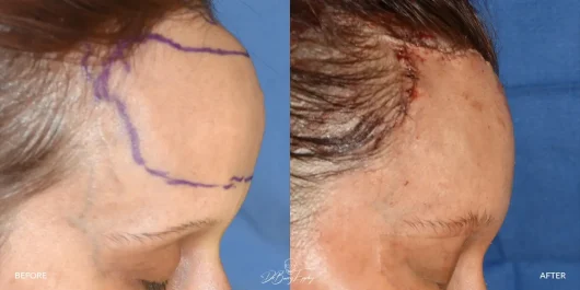 Before and after of patient with forehead reduction / recontouring