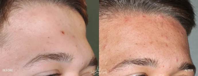 Before and after forehead horn reduction, procedure performed by Dr. Barry L. Eppley