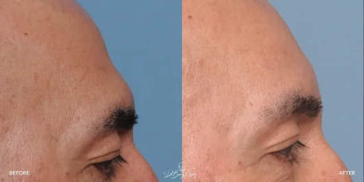 Suprabrow bone implant, before and after side view by Dr. Barry L. Eppley