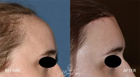 Female forehead reduction by hairline advancement by Dr. Barry Eppley