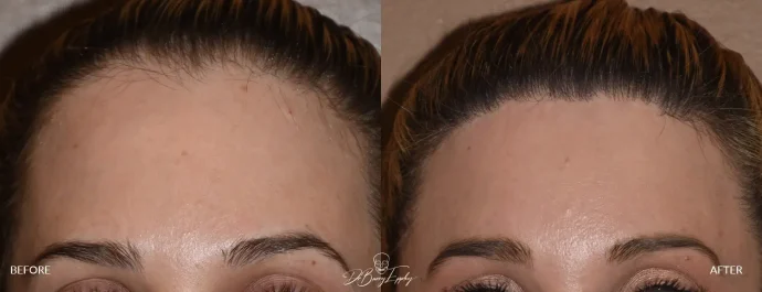 Frontal view of before and after female forehead reduction by hairline advancement by Dr. Barry Eppley