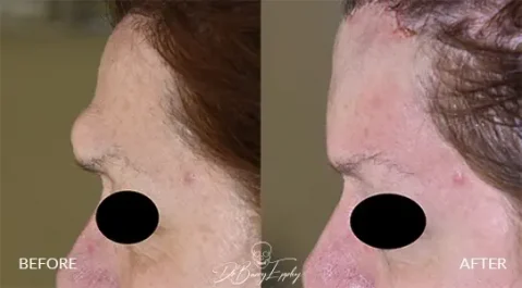Forehead osteoma excision before and after photo by Dr. Barry L. Eppley