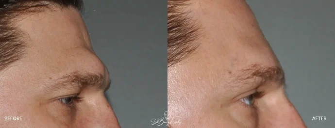 Before and after brow bone reduction on male by Dr. Barry Eppley