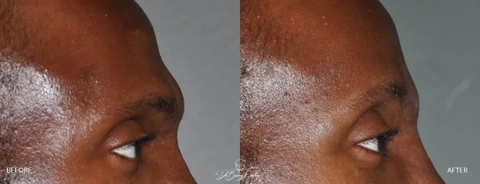 Male brow bone reduction by Dr. Eppley