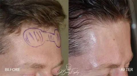 Male forehead horn reduction before and after by Dr. Barry L. Eppley