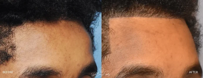 Male forehead horn reduction, oblique view. Before and after procedure performed by Dr. Barry Eppley