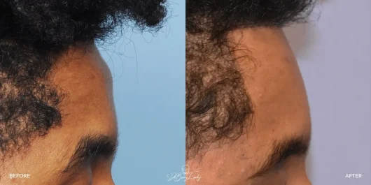Side view before and after forehead horn reduction. Procedure by Dr. Barry L. Eppley.