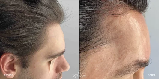 Before and after side view of sloped forehead implant by Dr. Eppley
