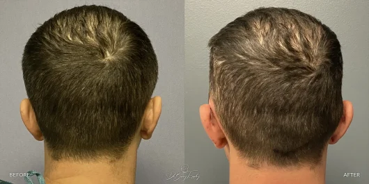 Back view before and after male temporal reduction