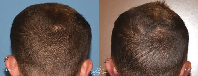 Before and after male temporal reduction, back view - Dr. Barry L. Eppley