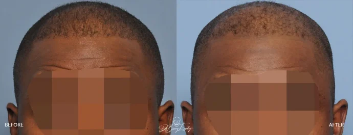 Male temporal reduction, before and after front view, by Dr. Eppley
