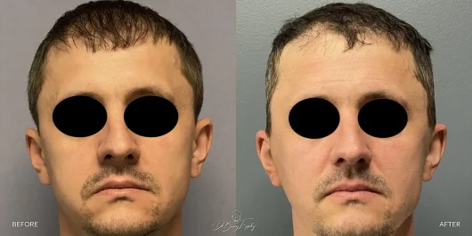 Male temporal reduction front, before and after by Dr. Barry Eppley