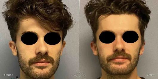 Male temporal reduction - front view before and after