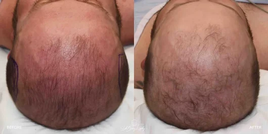 Male temporal reduction top view, before and after by Dr. Barry Eppley