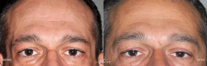 Before and after anterior temporal augmentation surgery by Dr. Barry L. Eppley
