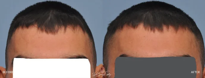 Before and after narrow head augmentation by Dr. Barry L. Eppley