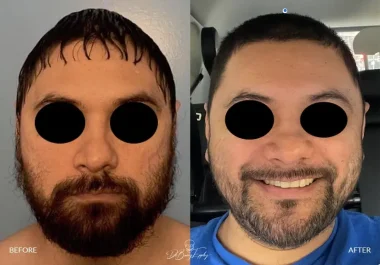 Before and after male total temporal augmentation by Dr. Barry Eppley