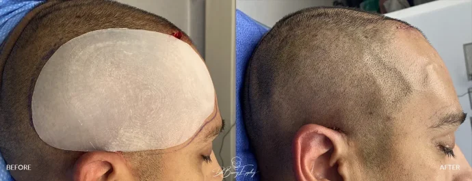 Before and after temporal forehead implant - Dr. Barry L. Eppley