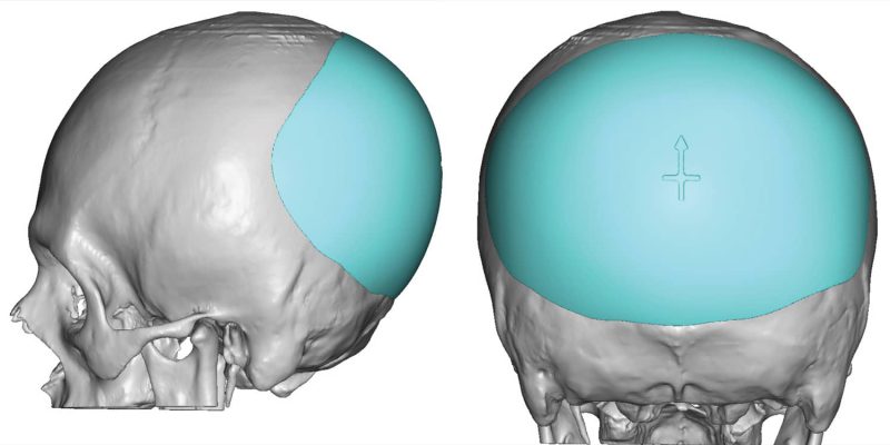 Occipital Surgery For Flat Spots On Head Dr Barry L Eppley