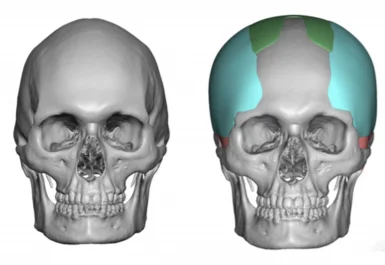 Before and after frontal view, 3d rendering of custom skull implant for narrow temples