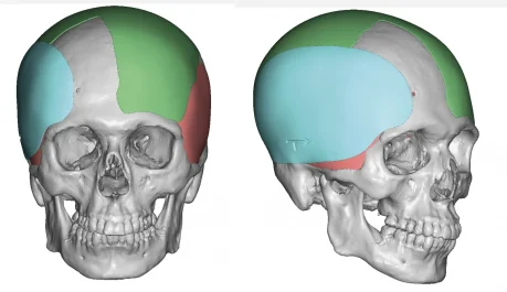 Right custom temporal implant design plagiocephaly front oblique view by Dr. Barry Eppley