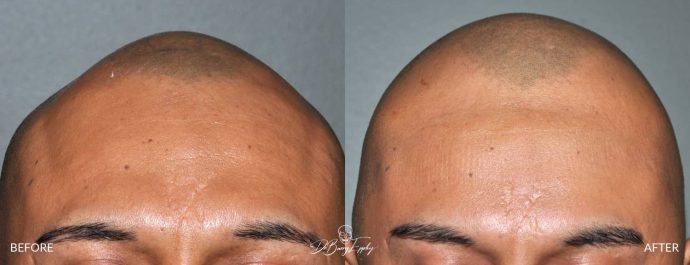 Skull reshaping before and after by Dr. Barry Eppley