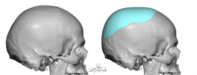 Custom skull implant design by Dr. Barry Eppley side view