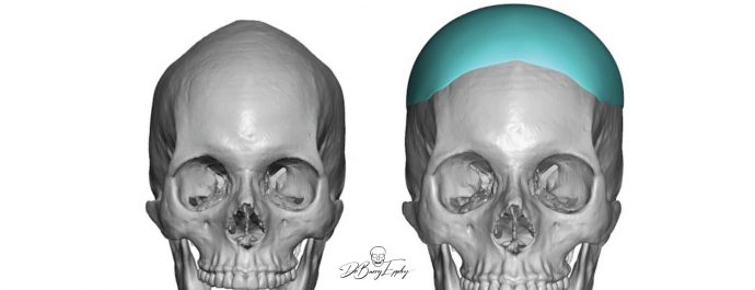 Custom skull implant design by Dr. Barry Eppley front view