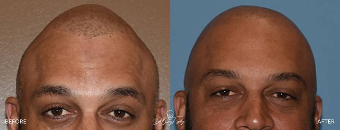 Parasagittal skull augmentation before and after by Dr. Barry Eppley