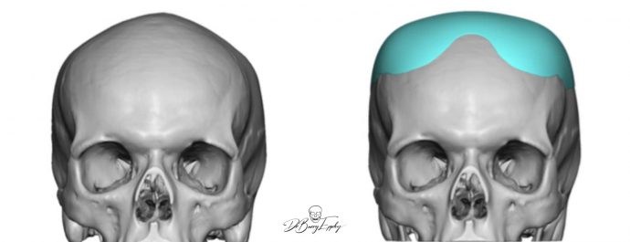 Custom parasagittal skull augmentation design front view