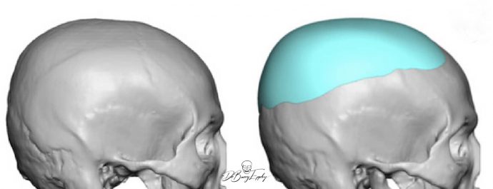 Custom parasagittal skull augmentation design side view