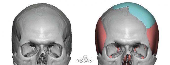 Custom parasagittal skull augmentation design by Dr. Barry Eppley