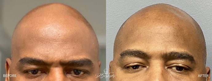 Skull reshaping before and after