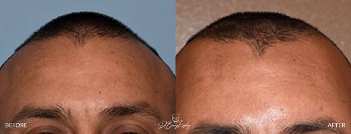 Before and after of anterior sagittal skull reduction front by Dr. Barry Eppley
