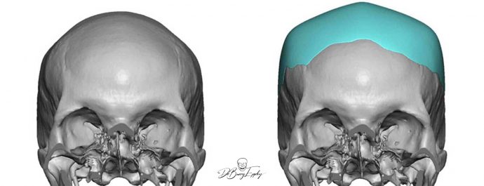 Square Custom Skull Implant design Dr Barry Eppley